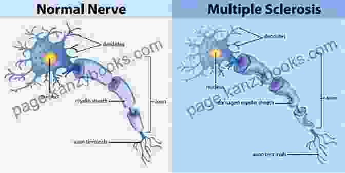 Demyelination Of Nerve Fibers In Multiple Sclerosis Do Viral Infections Trigger Severe Demyelinating DisFree Downloads Of The Central Nervous System? An Assessment With A Special Focus On Multiple Sclerosis And Acute Disseminated Encephalomyelitis