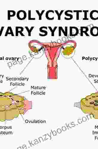 Infertility In Women With Polycystic Ovary Syndrome: Pathogenesis And Management